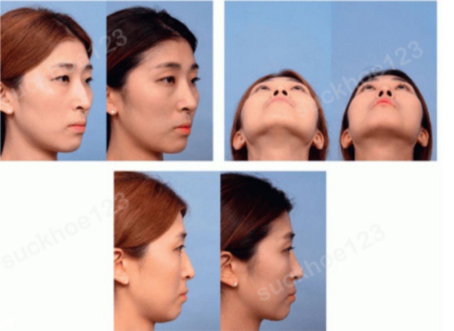 trước và sau phẫu thuật tạo hình đầu mũi bằng sụn vách ngăn