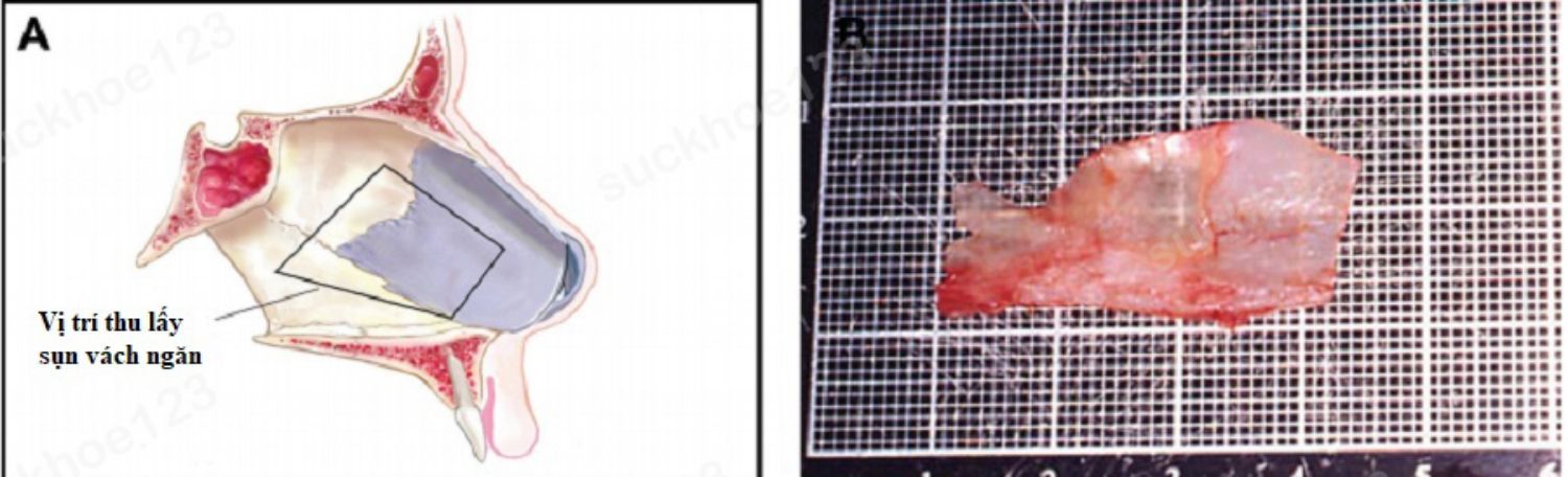 vị trí miếng sụn vách ngăn thu lấy được