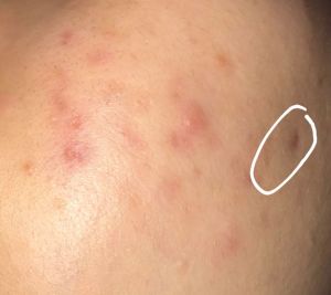 Dùng BHA trị mụn thì nên dùng sản phẩm gì?