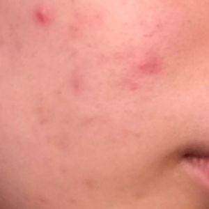 Dùng BHA trị mụn thì nên dùng sản phẩm gì?