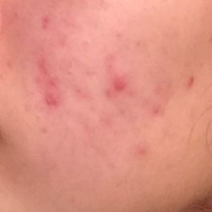 Dùng BHA trị mụn thì nên dùng sản phẩm gì?