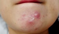 Cách điều trị và chăm sóc da bị mụn viêm? Cách điều trị và chăm sóc da bị mụn viêm?
