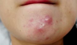 Cách điều trị và chăm sóc da bị mụn viêm?