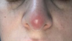 Đỏ đầu mũi sau 7 tháng phẫu thuật nâng mũi