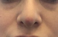 Đỏ đầu mũi sau 7 tháng phẫu thuật nâng mũi