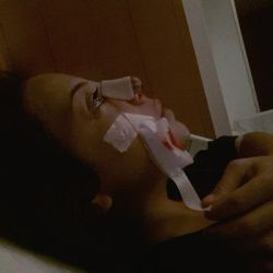 Dịch màu vàng rỉ ra từ mũi và bị đau, tức trán