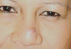 Xuất hiện mụn mủ màu vàng có phải là dấu hiệu áp xe mũi và nhiễm trùng?