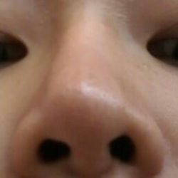 1 năm sau nâng: mũi lệch vẹo, tụt sụn