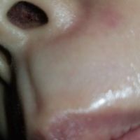 GẤP – liệu sụn tai có đùn hay lòi ra ở đầu mũi không? GẤP – liệu sụn tai có đùn hay lòi ra ở đầu mũi không?
