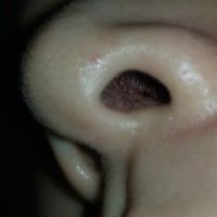 GẤP – liệu sụn tai có đùn hay lòi ra ở đầu mũi không? GẤP – liệu sụn tai có đùn hay lòi ra ở đầu mũi không?