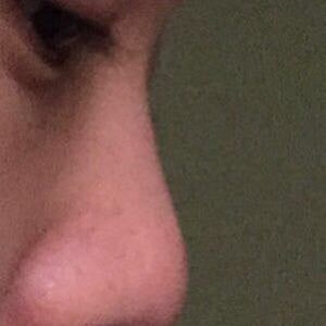 Lòi sụn Goretex, liệu chỉnh sửa lại có tiếp tục bị lòi sụn không?