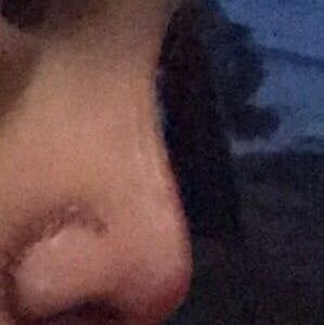 Lòi sụn Goretex, liệu chỉnh sửa lại có tiếp tục bị lòi sụn không?