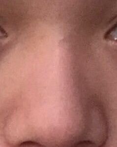 Lòi sụn Goretex, liệu chỉnh sửa lại có tiếp tục bị lòi sụn không?