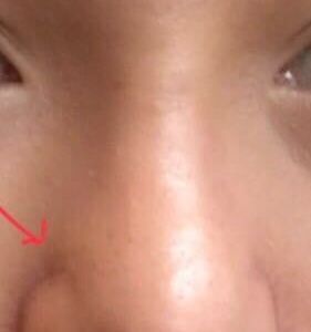 Lòi sụn Goretex, liệu chỉnh sửa lại có tiếp tục bị lòi sụn không?