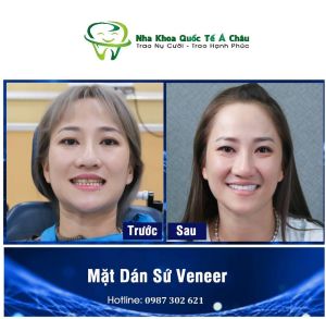 Hình ảnh dán sứ Veneer của chị Linh – Nha khoa Quốc tế Á Châu – Ca 1