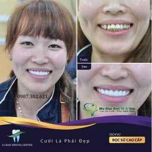 Hình ảnh bọc răng sứ - Nha khoa Quốc tế Á Châu – Ca 10