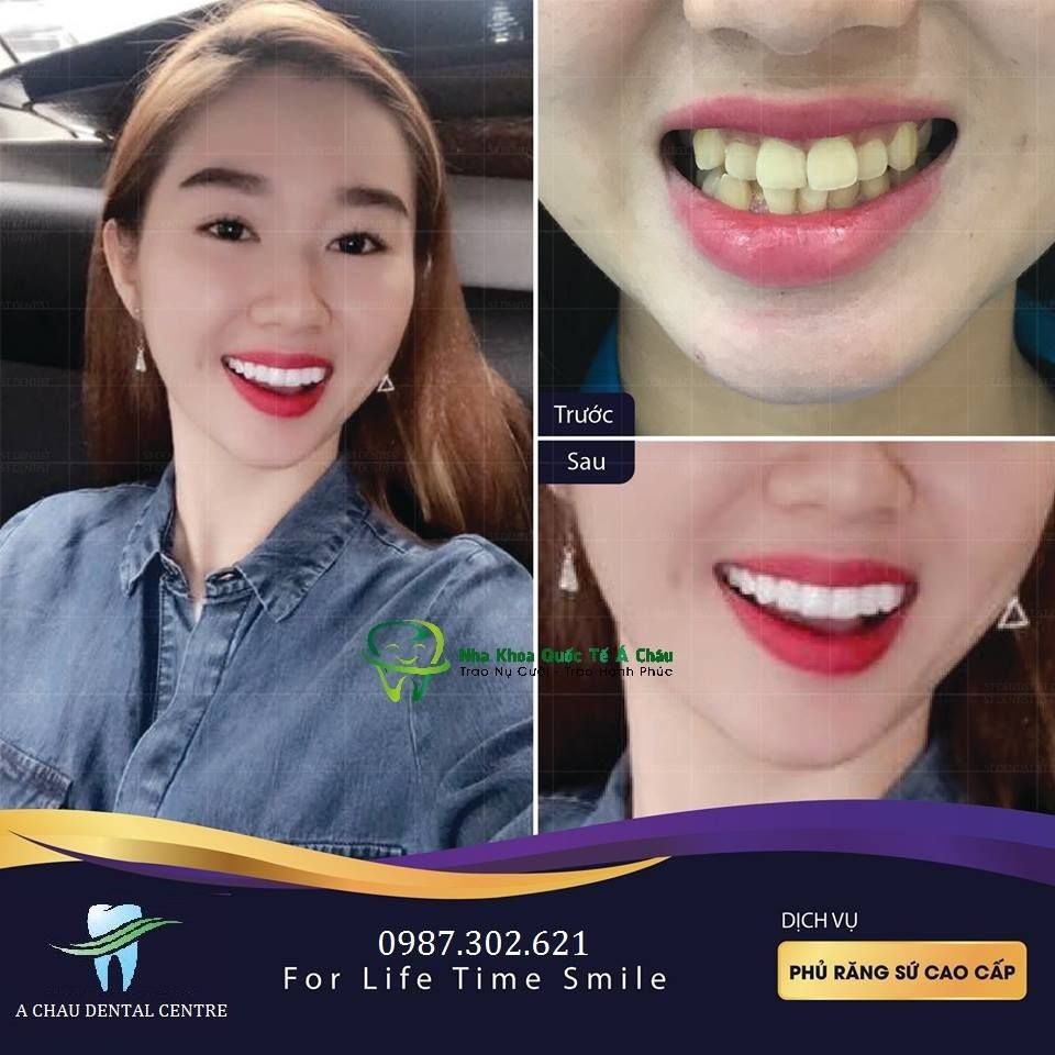 Hình ảnh bọc răng sứ Nacera – Nha khoa Quốc tế Á Châu – Ca 12