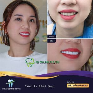 Hình ảnh bọc răng sứ - Nha khoa Quốc tế Á Châu – ca 13