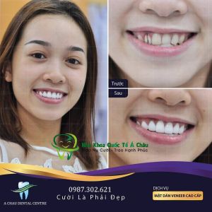 Hình ảnh bọc răng sứ cercon – Nha khoa Quốc tế Á Châu – Ca 14