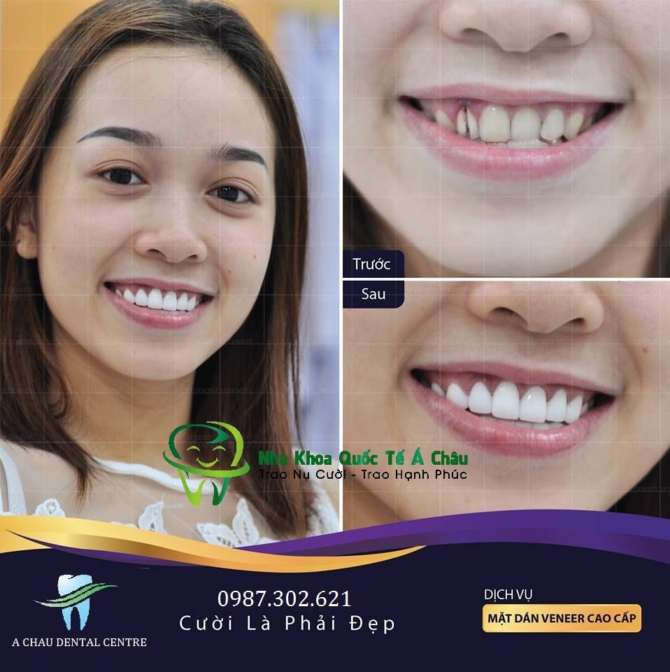 Hình ảnh bọc răng sứ cercon – Nha khoa Quốc tế Á Châu – Ca 14