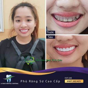 Hình ảnh bọc răng sứ - Nha khoa Quốc tế Á Châu – Ca 16