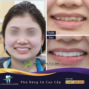Hình ảnh bọc răng sứ - Nha khoa Quốc tế Á Châu – Ca 17