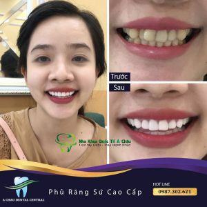 Hình ảnh bọc răng sứ - Nha khoa Quốc tế Á Châu – Ca 18