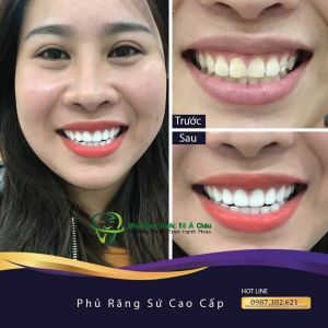 Hình ảnh bọc răng sứ của KH Hồng Anh – Nha khoa Quốc tế Á Châu – Ca 19