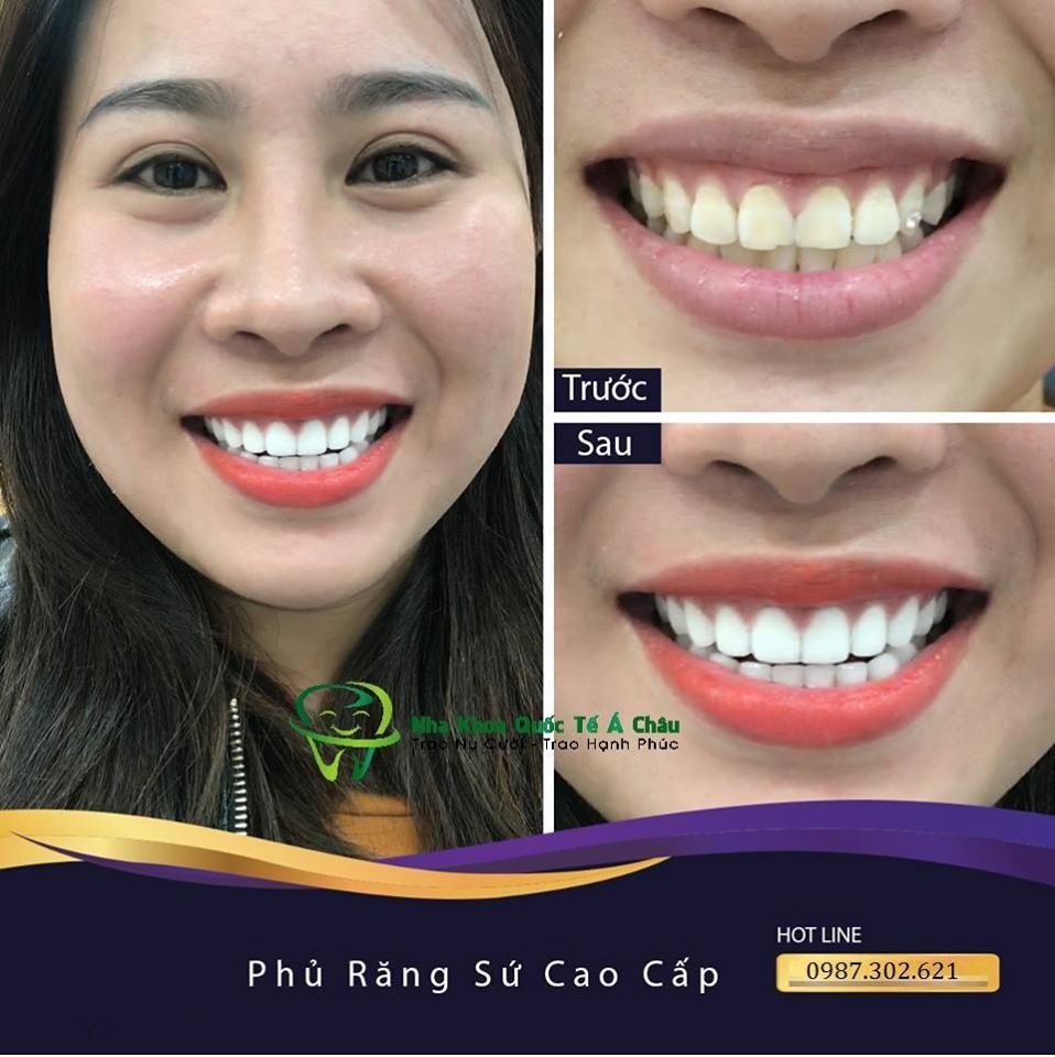 Hình ảnh bọc răng sứ của KH Hồng Anh – Nha khoa Quốc tế Á Châu – Ca 19