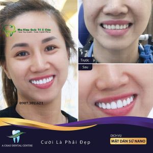 Hình ảnh bọc răng sứ - Nha khoa Quốc tế Á Châu – ca 2