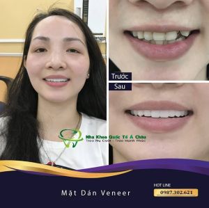 Hình ảnh bọc răng sứ của KH Minh Nguyệt – Nha khoa Quốc tế Á Châu – Ca 21