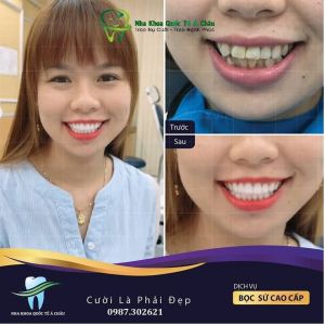 Hình ảnh bọc răng sứ - Nha khoa Quốc tế Á Châu – Ca 22