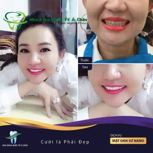 Hình ảnh bọc răng sứ của Kim Oanh – Nha khoa Quốc tế Á Châu – Ca 23