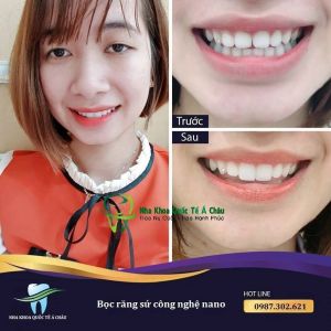 Hình ảnh bọc răng sứ - Nha khoa Quốc tế Á Châu – Ca 24