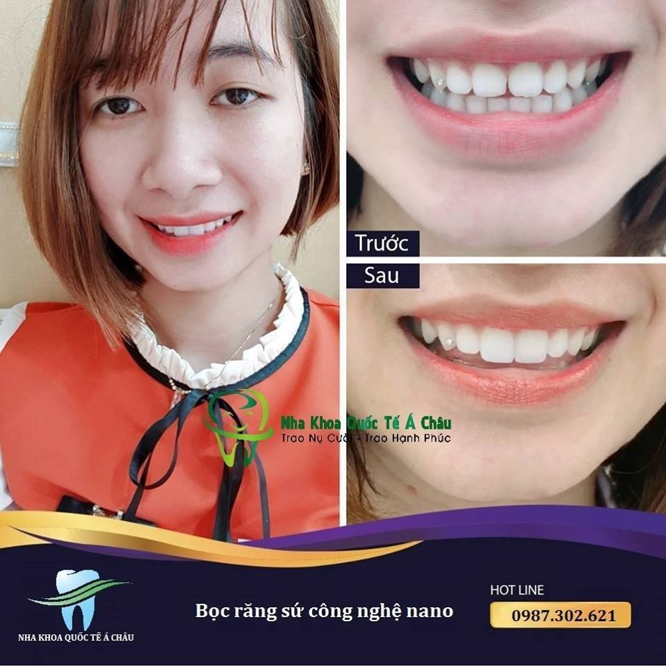 Hình ảnh bọc răng sứ - Nha khoa Quốc tế Á Châu – Ca 24