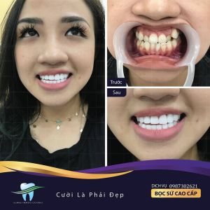 Hình ảnh bọc răng sứ của Hà Anh – Nha khoa Quốc tế Á Châu – Ca 25