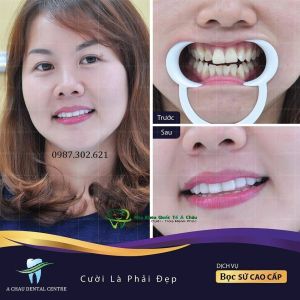 Hình ảnh bọc răng sứ của KH Yến Trang - Nha khoa Quốc tế Á Châu – Ca 3