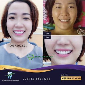 Hình ảnh bọc răng sứ - Nha khoa Quốc tế Á Châu – Ca 4