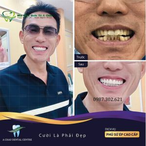 Hình ảnh dán sứ Veneer – Nha khoa Quốc tế Á Châu – Ca 5