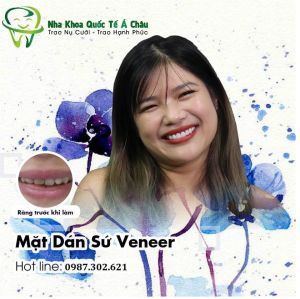 Hình ảnh dán sứ Veneer – Nha khoa Quốc tế Á Châu – Ca 6