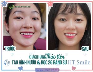 Hình ảnh bọc răng sứ và cắt lợi của Thảo Tiên – Nha khoa Quốc tế Á Châu – Ca 7
