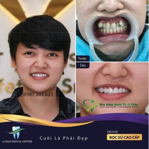 Hình ảnh bọc răng sứ - Nha khoa Quốc tế Á Châu – Ca 8