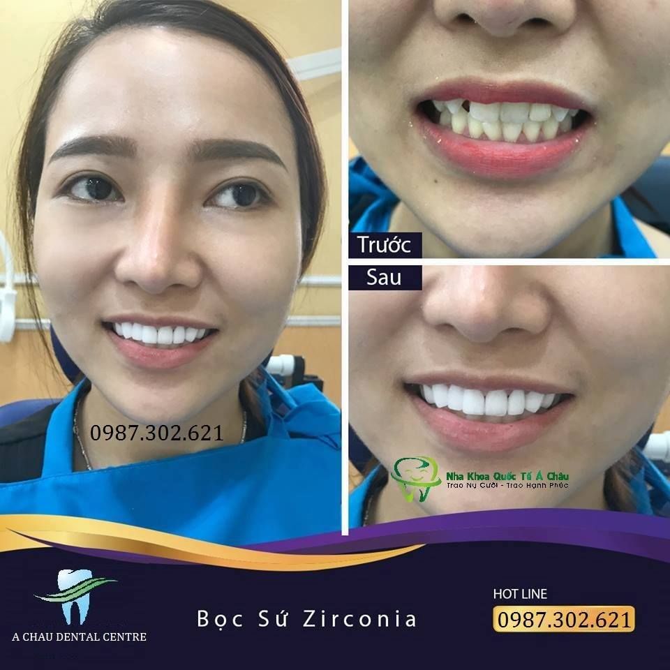 Hình ảnh bọc răng sứ - Nha khoa Quốc tế Á Châu – Ca 9