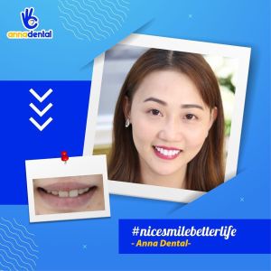 Hình ảnh bọc răng sứ - Nha khoa Anna – Ca 1