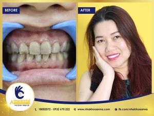 Hình ảnh bọc răng sứ - Nha khoa Anna – Ca 12