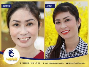 Hình ảnh bọc răng sứ - Nha khoa Anna – Ca 13