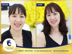 Hình ảnh bọc răng sứ - Nha khoa Anna – Ca 14