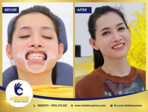 Hình ảnh dán sứ Veneer – Nha khoa Anna – Ca 15