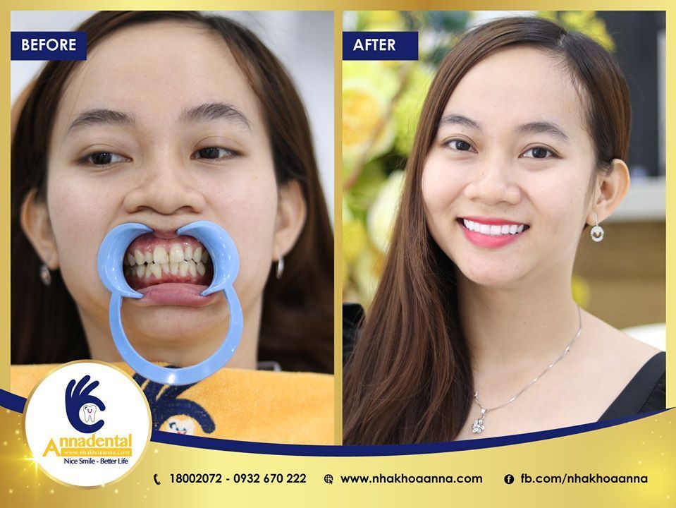 Hình ảnh bọc răng sứ - Nha khoa Anna – Ca 16