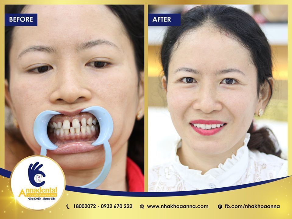 Hình ảnh bọc răng sứ - Nha khoa Anna – Ca 17